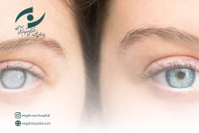 عمل آب مروارید