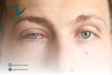 آلرژی چشمی