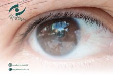 ناخنک چشم یا پتریژیوم