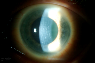 Right cornea